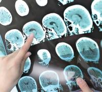 Pfizer ocultou indícios de que um de seus fármacos poderia prevenir o Alzheimer