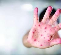 OMS: mais da metade do mundo está em alto risco para surto de sarampo