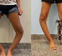 Técnica inovadora corrige deformidades nas pernas de crianças e jovens