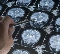 Alzheimer pode ser doença autoimune do cérebro, sugere pesquisador