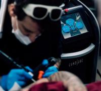 Remoção de tatuagens exige cuidados especiais
