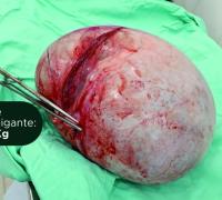 Procedimento cirúrgico retira cisto de ovário gigante com 8,600 Kg em Xique-Xique
