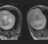 Menina passa por cirurgia para retirar feto de irmão gêmeo do crânio