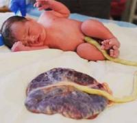 Pesquisa desenvolve curativos biológicos à base de placenta