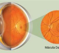 Saiba o que é Degeneração Macular